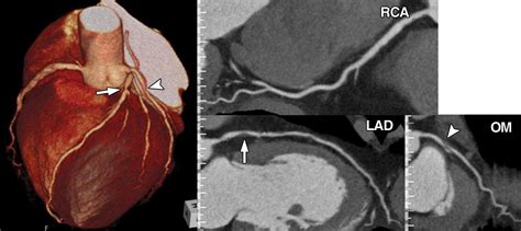 Prospective Ecg Gated Coronary Mdct Angiography With Absolute