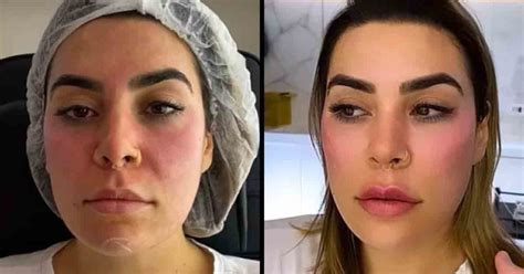 Antes E Depois Veja Os Famosos Que Fizeram Harmoniza O Facial