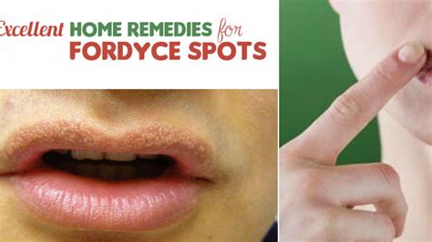 Fordyce Spots On Lips Treatment Apple Cider Vinegar And Honey