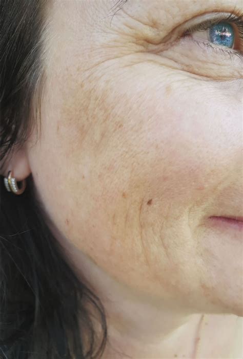 Unmasking The Causes And Treatments Of Melasma Harvard Health