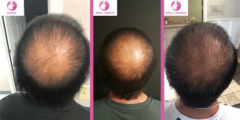 Knoxville Prp Injections For Hair Loss Pretty Girl Aesthetics