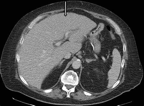 Cureus An Unusual Presentation Of Primary Hepatic Diffuse Large B