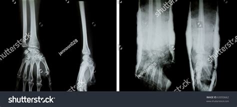 X Ray Of Both Human Arms Normal Arms And Arms With Splint Stock