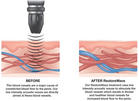Acoustic Wave Therapy Precise Men S Medical