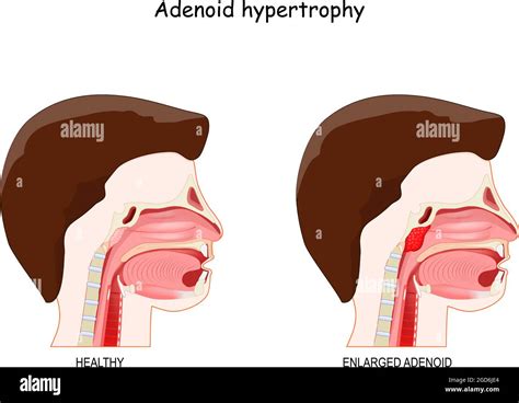 Enlarged Adenoids Stock Vector Images Alamy