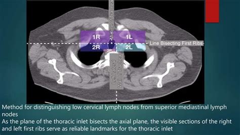 Radiological Anatomy Of Thoracic Lymph Nodes