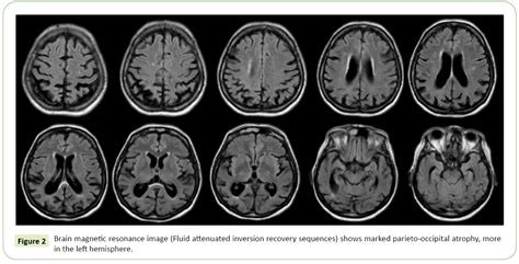 A Case Of Posterior Cortical Atrophy With Complex Set Of Symptoms