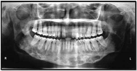 Langerhans Cell Histiocytosis Lch Of The Mandible In An Adult A Rare