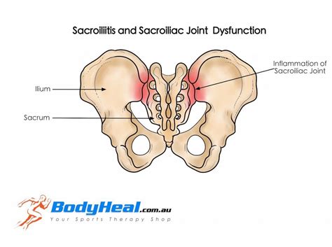 What Is Sacroiliitis Sacroiliac Joint Dysfunction Causes Symptoms