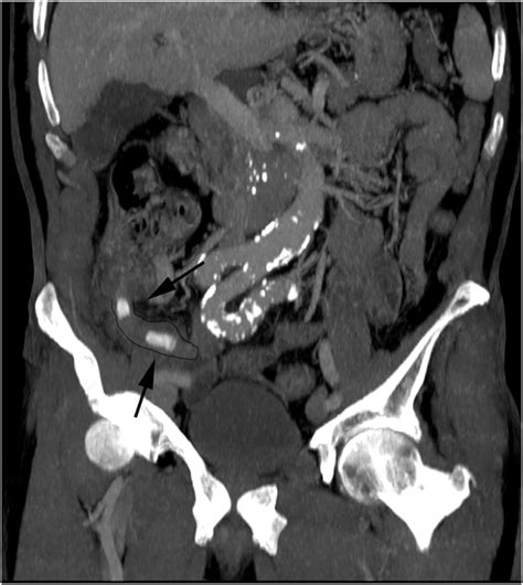 Ct Scan Showing Perforated Appendix Containing Two Appendicoliths