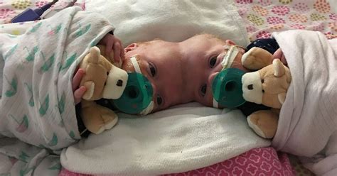 Rare Conjoined Twins Born Fused By Their Skulls Successfully Separated