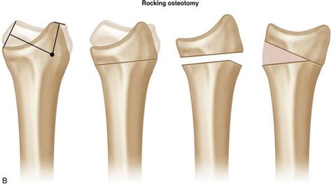 80 Corrective Osteotomy Of Malunited Distal Radius Fractures