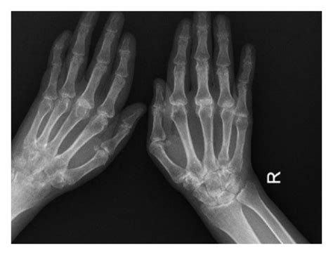 A Right Hand With Swan Neck And Z Deformity Of The Thumb Before