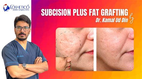 Subcision Plus Fat Grafting Acne Scars Treatment Dr Kamal Ud Din