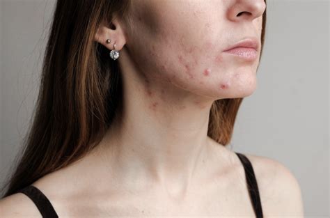How Do You Know If Your Acne Is Hormonal Illuminate Skin Clinics
