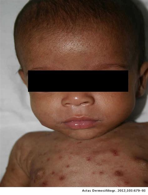 Congenital Syphilis In The 21st Century Actas Dermo Sifiliográficas