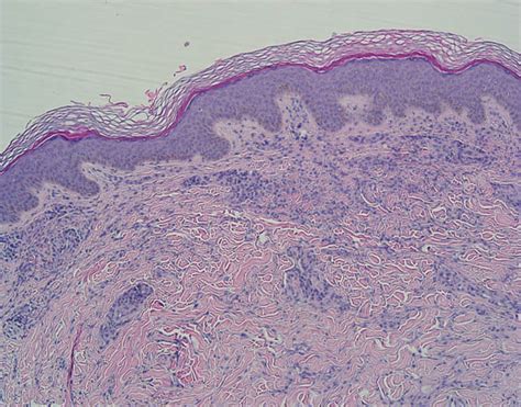 Palisaded Neutrophilic Granulomatous Dermatitis With Concomitant