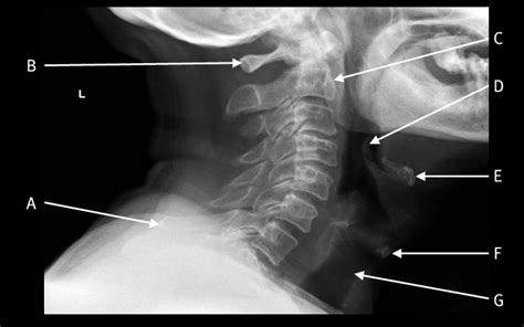 Radiographic Anatomy Of The Skeleton Cervical Spine L