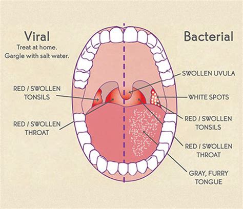 Tonsillitis Sore Throat The Ent Clinic