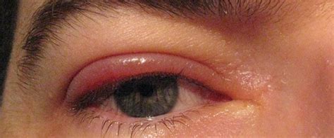 What Causes Swollen Eyelids Eye Disorders And Diseases Medical