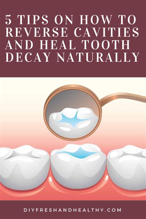 These tips are just a few ways to reverse tooth decay. 5 Tips on How to Reverse Cavities And Heal Tooth Decay ...
