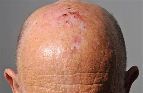 Skin Cancer Bump On Scalp
