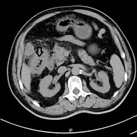 A Ct Scan With Contrast Showing Air In The Gallbladder Arrow