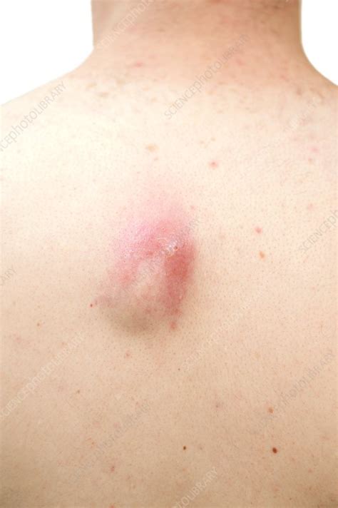 Abscess On The Back Stock Image C0103233 Science Photo Library