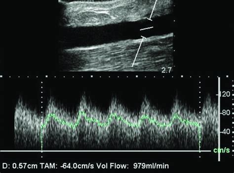 7 Doppler Ultrasound Evaluation Of Avf Ow Doppler Ultrasound May Be