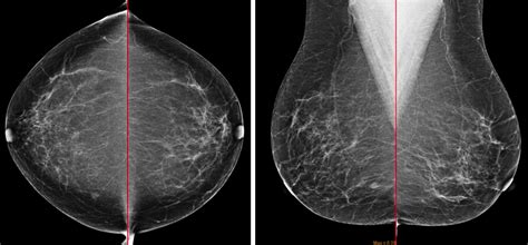 Medullary Carcinoma Of The Breast Radiology Education Seminars
