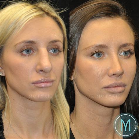 Gary Motykie Md Facs On Instagram “⚕️ Revision Rhinoplasty 💬 This 30 Year Old Patient That