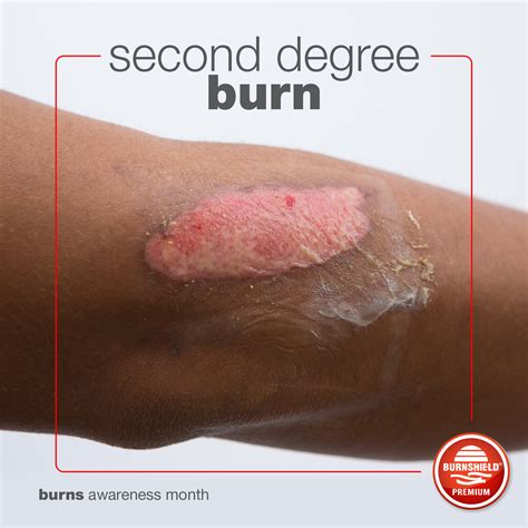 Second Degree Burn Pictures