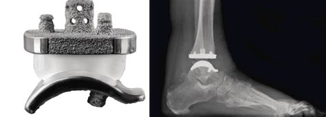 Total Ankle Replacement Surgery Sarasota Fl Florida Orthopedic Foot