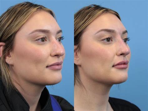 dermal fillers before and after pictures case 177 west des moines ia