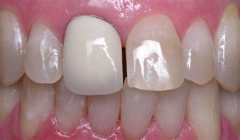 Teeth Whitening Smile Gallery