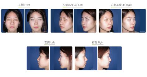 Malar Implant Face Surgery Wish Aesthetic Surgery Clinic