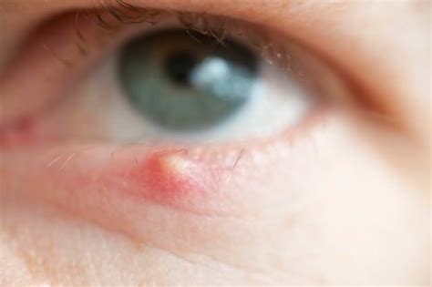 Chalazion And Eyelid Cyst Removal What You Must Be Aware Of Raymond M