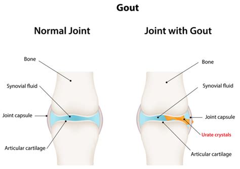 Maybe you would like to learn more about one of these? How Long Does Gout Last? These 3 Factors Determine the ...