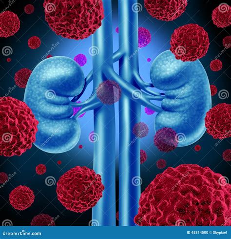 Cancer De Rein Illustration Stock Illustration Du Biologie 45314500