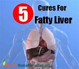 Home Remedies Fatty Liver Pictures