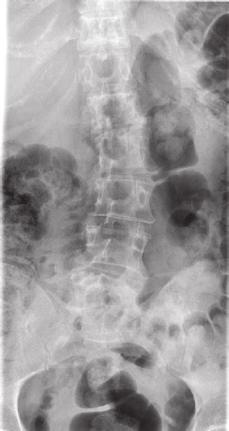 Lytic Vertebral Lesions Mainly On L1 The Radiological Aspects Of The