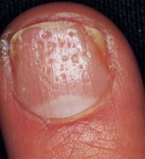 Dents On Nails Causes When Small Vertical Horizontal And Treatment