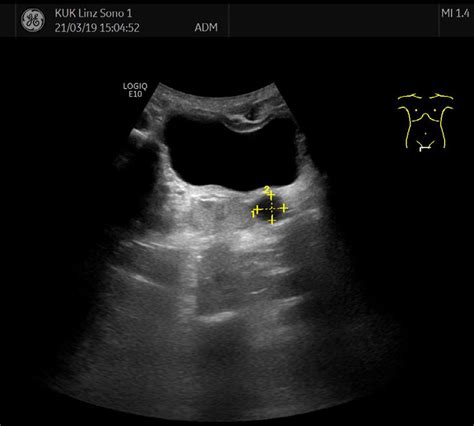 Sonography Of The Abdomen Showing A Cystic Lesion 13 Cm In Size