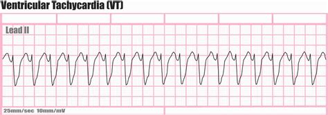 Ventricular Tachycardia Causes Symptoms Diagnosis Prognosis Treatment