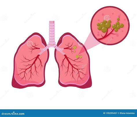Lung Cancer Concept On White Background Stock Vector Illustration Of