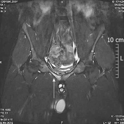Magnetic Resonance Imaging Stage Osteitis Pubis In A Year Old