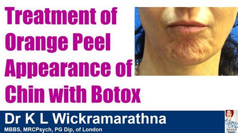 Treatment Of Orange Peel Appearance Of Chin With Botox Youtube