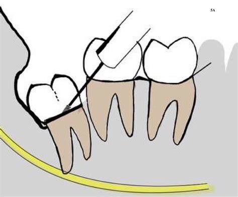 Does The Tooth Sectioning Method Impact Surgical Removal Of The