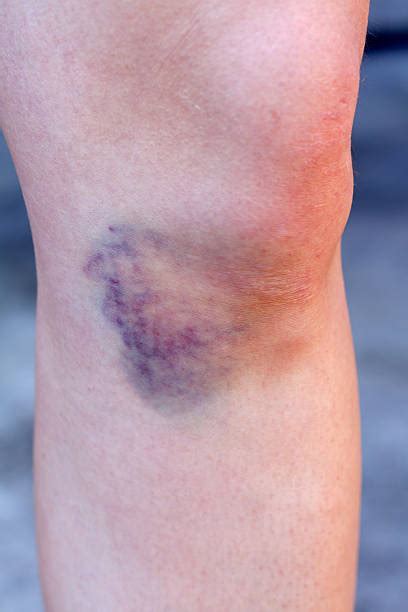 Picture Of Hematoma Pictures Stock Photos Pictures And Royalty Free