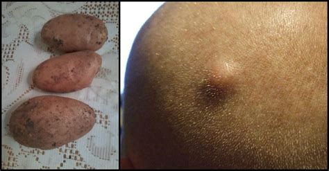 9 Ways To Safely Treat A Pesky Sebaceous Cyst Right At Home Cysts